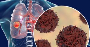 Triệu chứng của ung thư phổi giai đoạn sớm