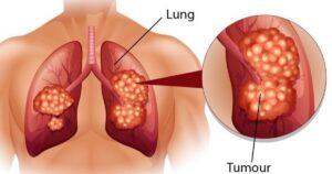 5 triệu chứng thường gặp ở bệnh nhân ung thư phổi