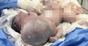 Bé trai mới sinh ở TPHCM đã mang "miệng ếch" khổng lồ, đầu lệch sang trái