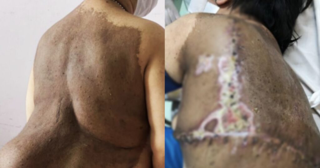 Người phụ nữ ở TPHCM mang "mai rùa" khổng lồ trên lưng vì căn bệnh hiếm