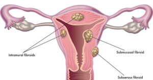 U xơ tử cung có dẫn đến ung thư không?