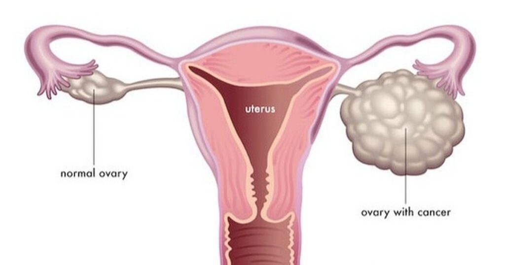 Ung thư buồng trứng giai đoạn 3 điều trị như thế nào?