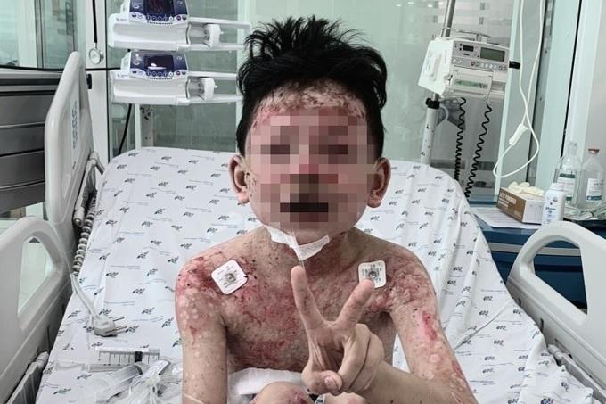 Bé trai 8 tuổi lở loét khắp người, nhiễm trùng nặng nề sau khi ăn cua