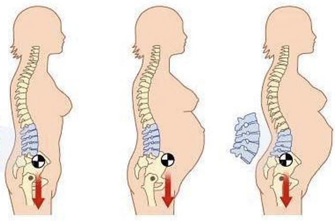 Gù lưng, thoái hóa khớp, đổi dáng sau khi mang thai và khuyến cáo từ bác sĩ