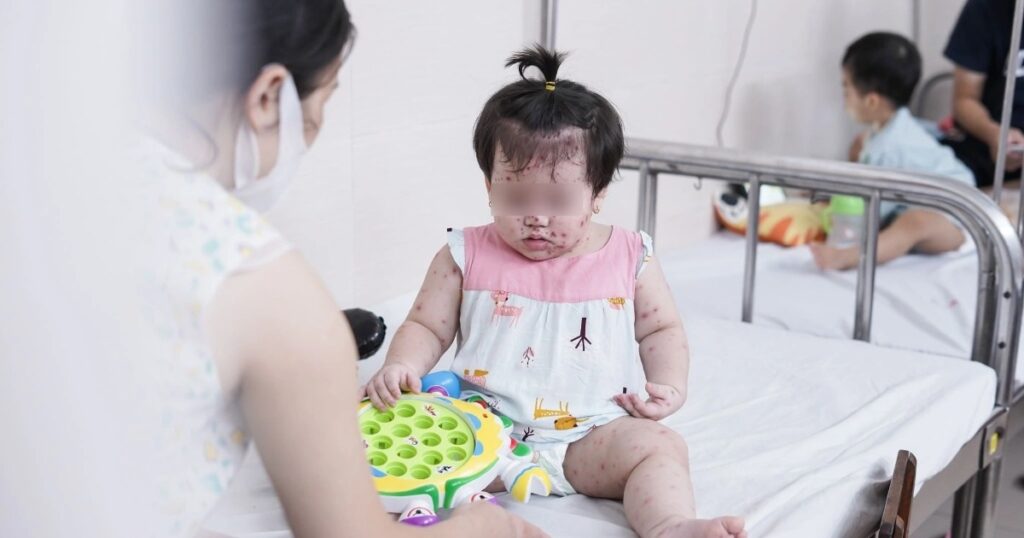 Tay chân miệng tại Hà Nội vào đỉnh dịch: Triệu chứng nguy hiểm nhất